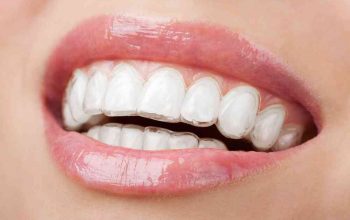 How Long Will It Take to Straighten My Teeth with Braces?